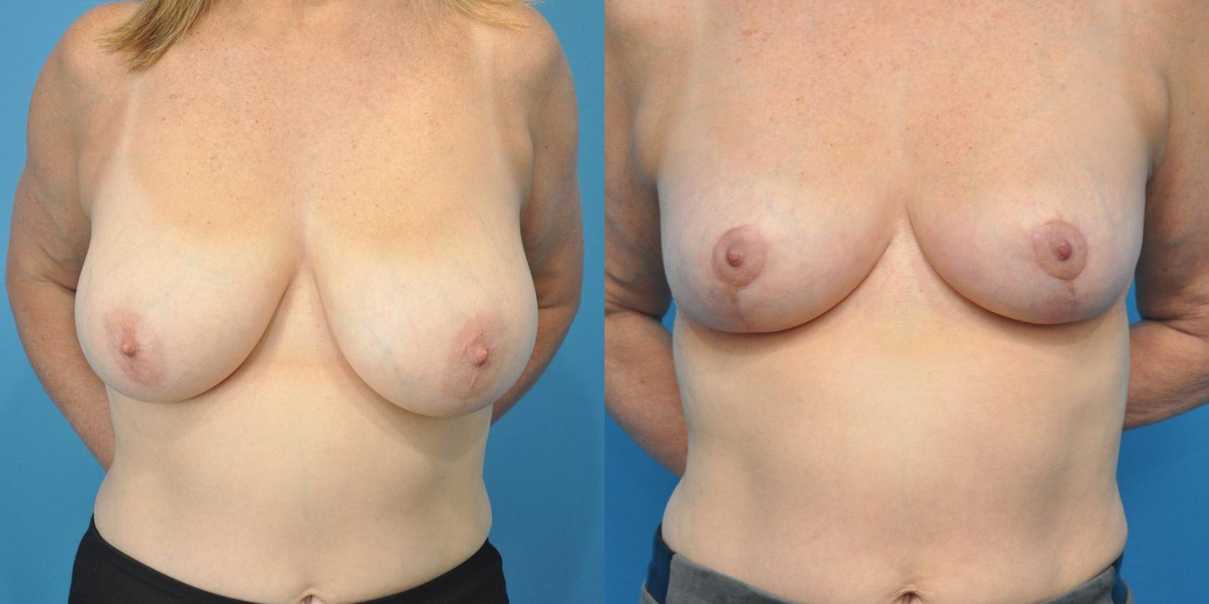 Before & After Breast Lift (Mastopexy) Case 149 View #1 View in North Shore, IL