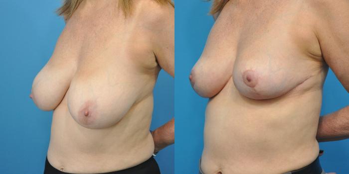 Before & After Breast Lift (Mastopexy) Case 149 View #2 View in North Shore, IL