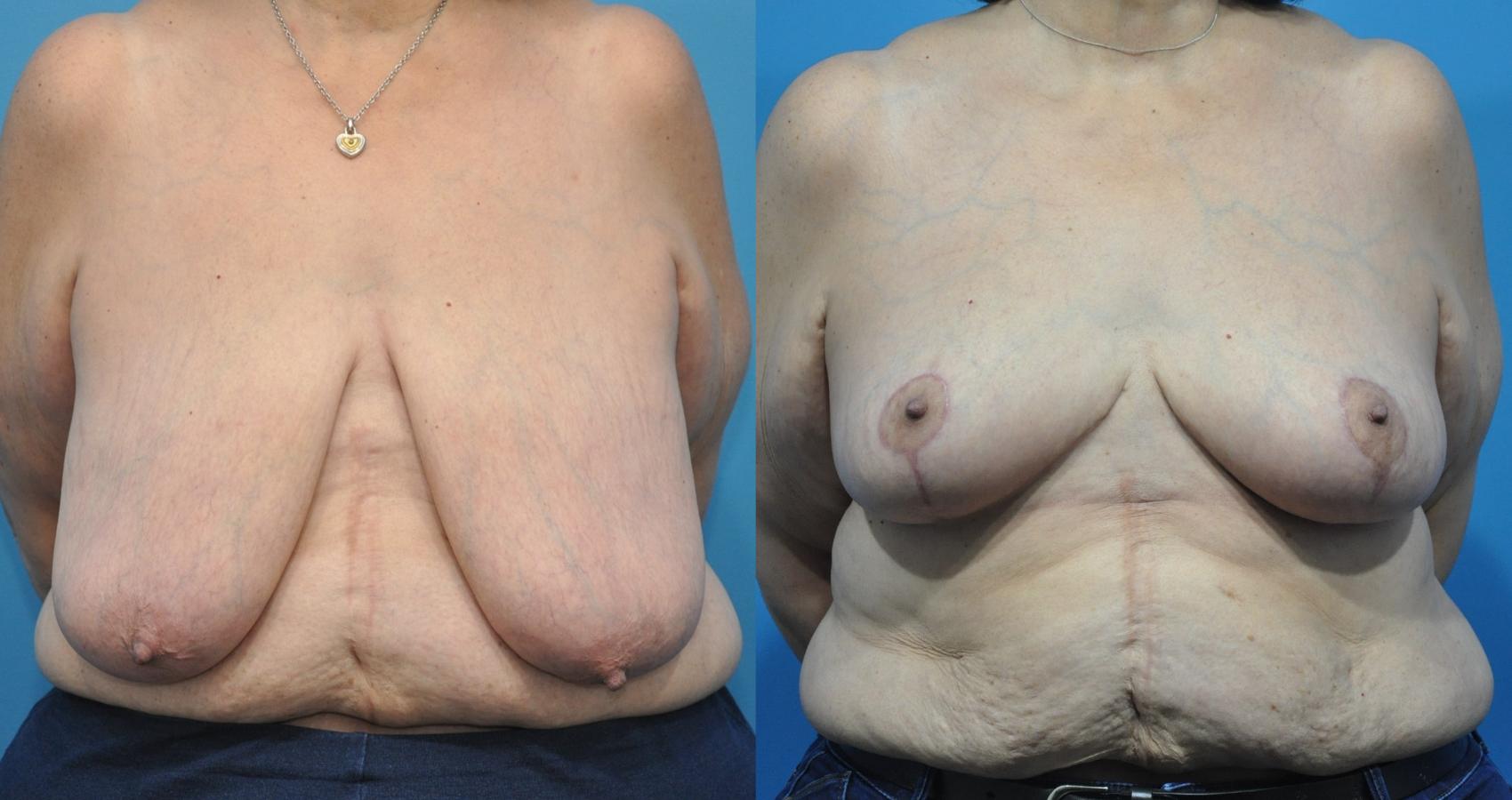 Before & After Breast Lift (Mastopexy) Case 163 View #1 View in Northbrook, IL