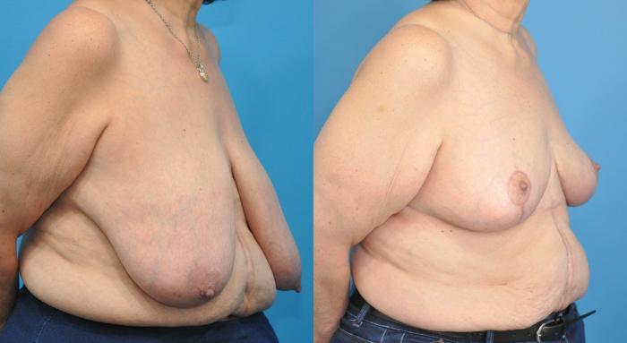 Before & After Breast Lift (Mastopexy) Case 163 View #2 View in Northbrook, IL