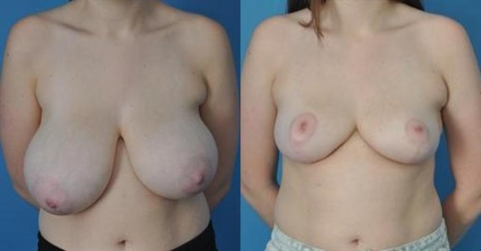 Before & After Breast Lift (Mastopexy) Case 18 View #1 View in Northbrook, IL