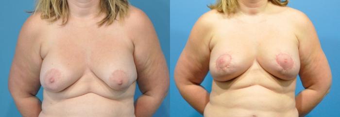 Before & After Breast Lift (Mastopexy) Case 207 View #1 View in North Shore, IL