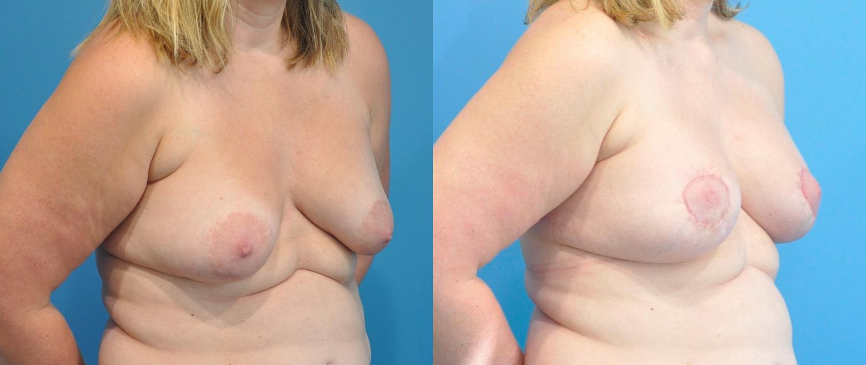 Before & After Breast Lift (Mastopexy) Case 207 View #2 View in Northbrook, IL