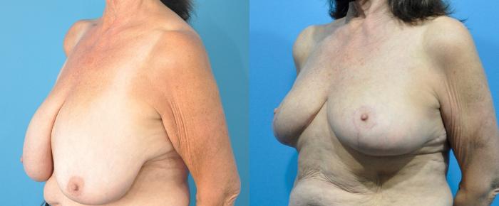 Before & After Breast Lift (Mastopexy) Case 212 Left Oblique View in North Shore, IL
