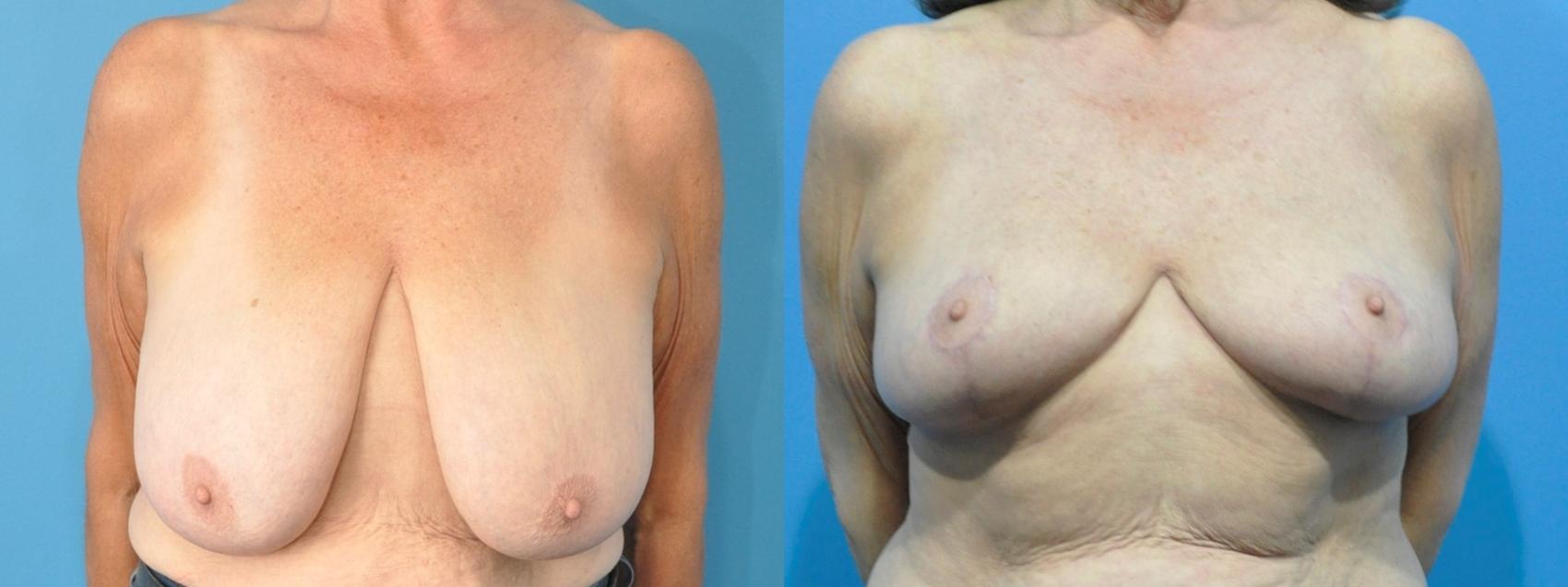 Before & After Breast Lift (Mastopexy) Case 212 View #1 View in North Shore, IL