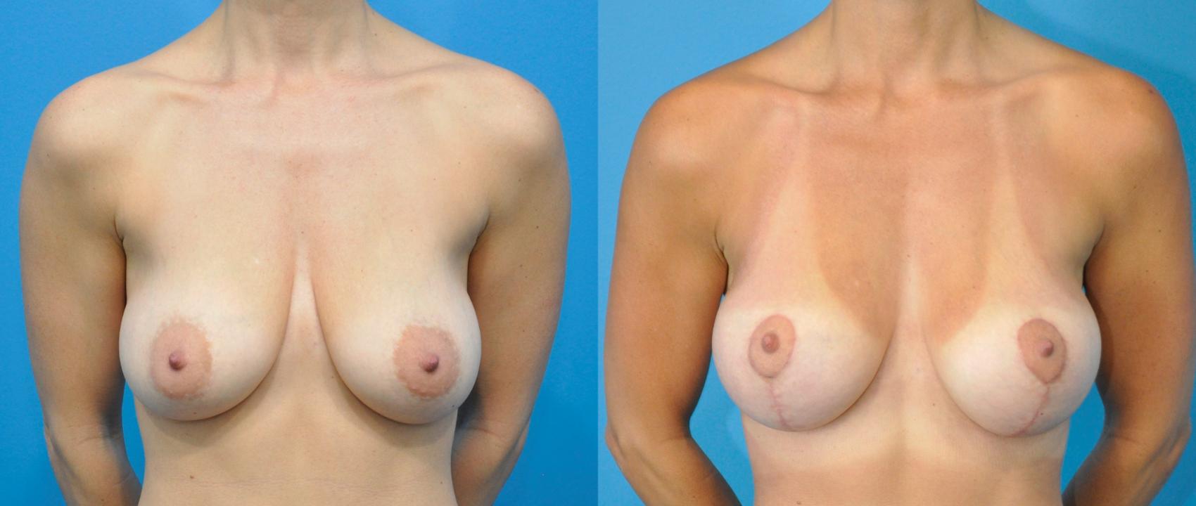Before & After Breast Lift (Mastopexy) Case 231 View #1 View in Northbrook, IL