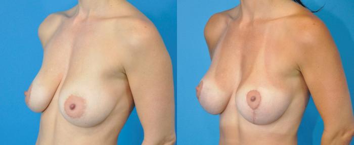 Before & After Breast Lift (Mastopexy) Case 231 View #2 View in Northbrook, IL