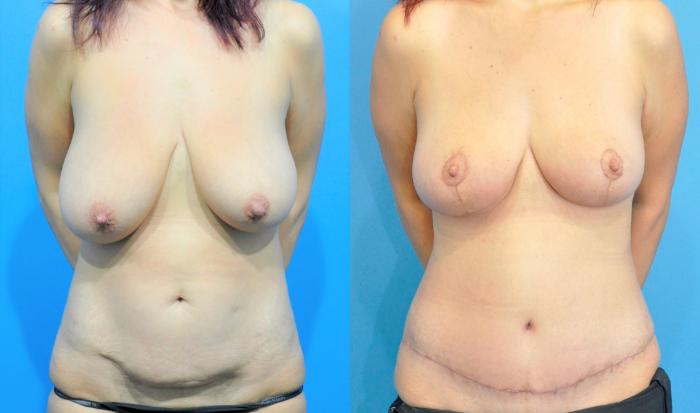 Before & After Breast Lift (Mastopexy) Case 232 View #1 View in Northbrook, IL