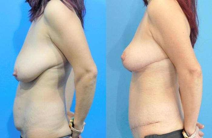 Before & After Breast Lift (Mastopexy) Case 232 View #3 View in Northbrook, IL
