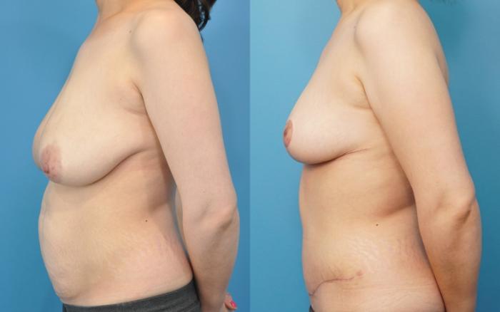 Before & After Breast Lift (Mastopexy) Case 240 View #1 View in North Shore, IL