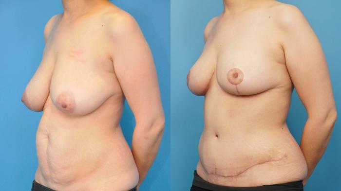 Before & After Breast Lift (Mastopexy) Case 240 View #2 View in North Shore, IL