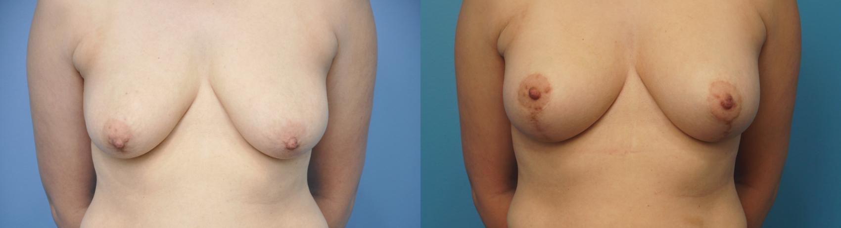 Before & After Breast Lift (Mastopexy) Case 246 View #1 View in Northbrook, IL