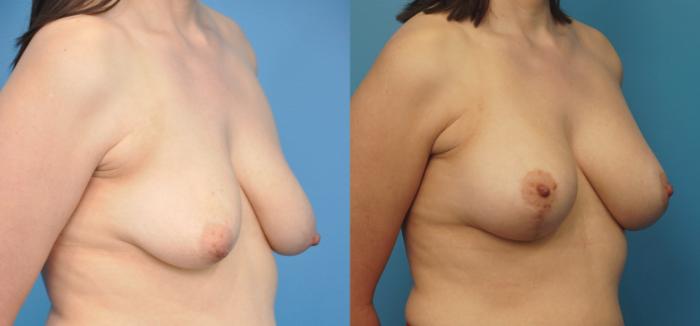 Before & After Breast Lift (Mastopexy) Case 246 View #3 View in North Shore, IL