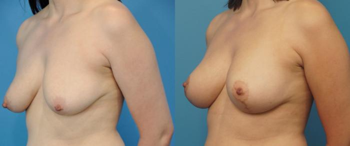 Before & After Breast Lift (Mastopexy) Case 246 View #5 View in North Shore, IL