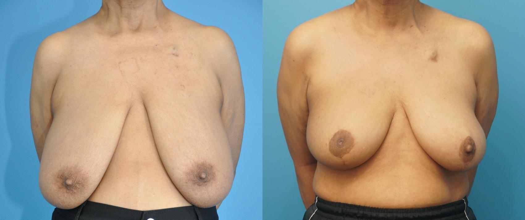 Before & After Oncoplastic Breast Reconstruction after Lumpectomy Case 280 Front View in Northbrook, IL
