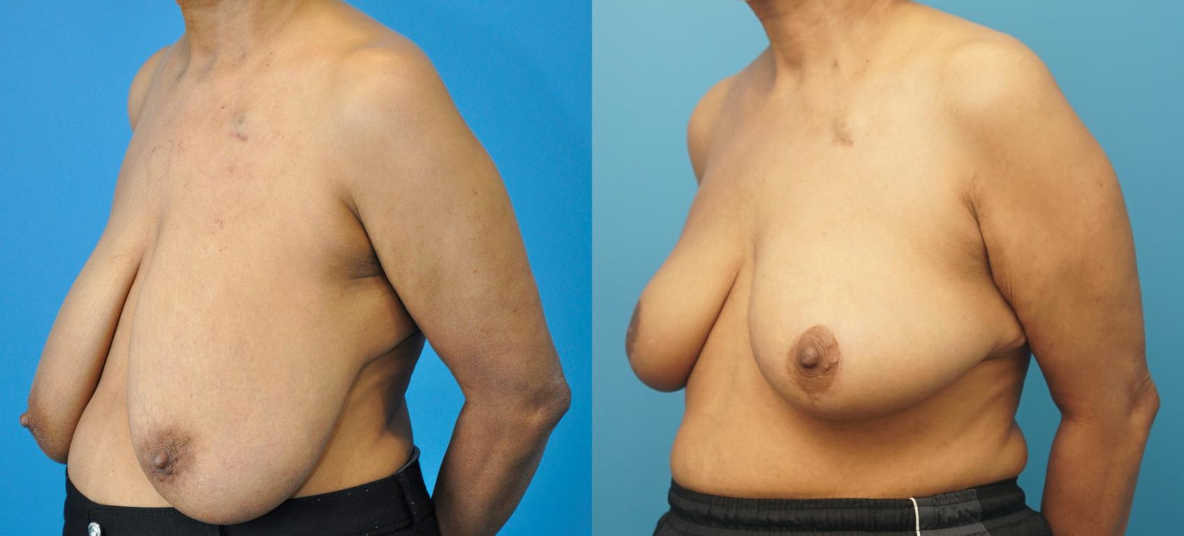 Before & After Oncoplastic Breast Reconstruction after Lumpectomy Case 280 Left Oblique View in Northbrook, IL