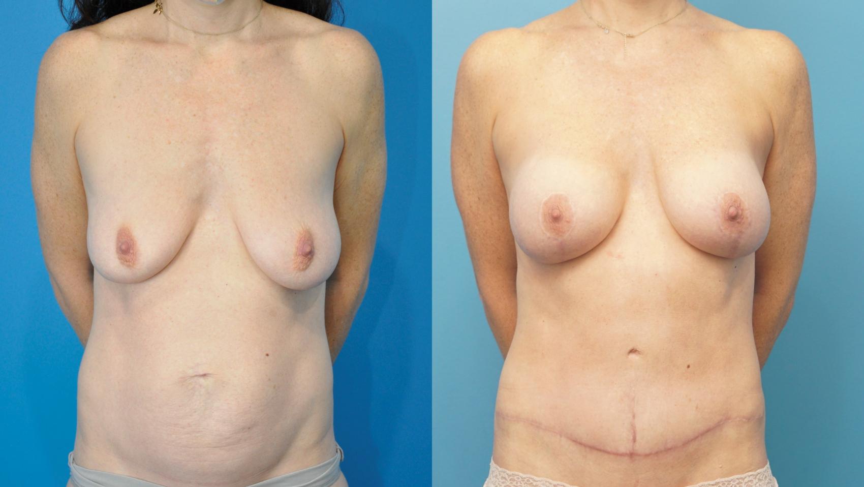 Before & After Breast Augmentation Case 289 Front View in North Shore, IL