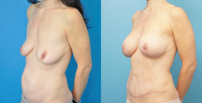 Before & After Breast Lift (Mastopexy) Case 289 Left Oblique View in North Shore, IL