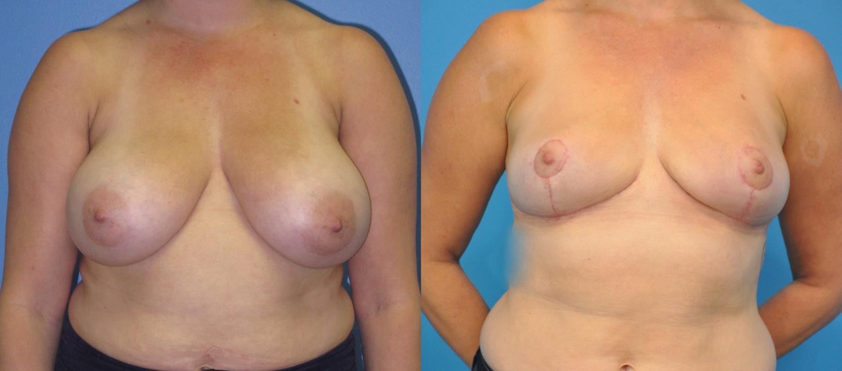 Before & After Breast Lift (Mastopexy) Case 29 View #1 View in Northbrook, IL