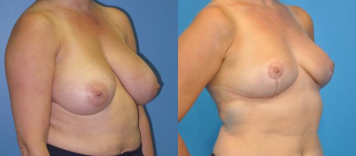 Before & After Breast Lift (Mastopexy) Case 29 View #2 View in North Shore, IL