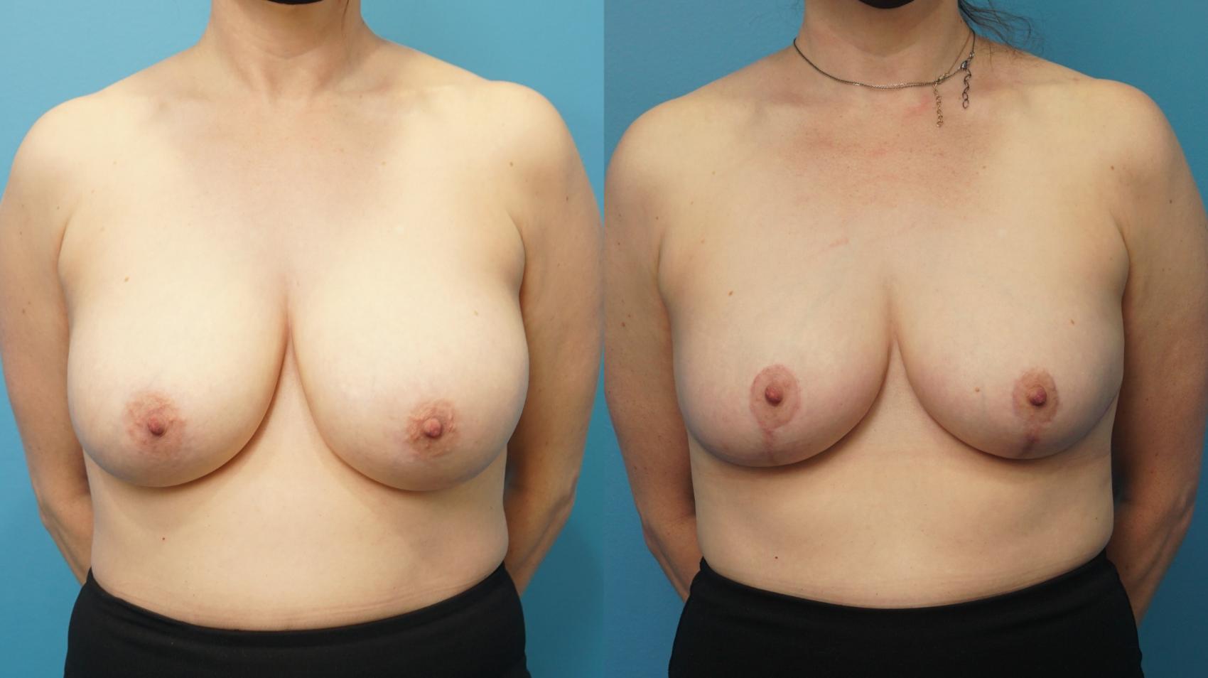 Before & After Breast Augmentation Case 300 View #1 View in North Shore, IL