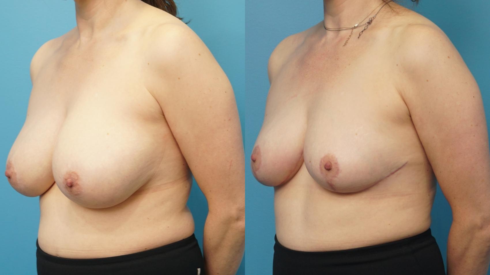 Before & After Breast Lift (Mastopexy) Case 300 View #2 View in Northbrook, IL