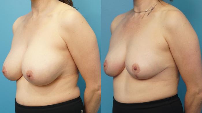 Before & After Breast Augmentation Case 300 View #2 View in North Shore, IL