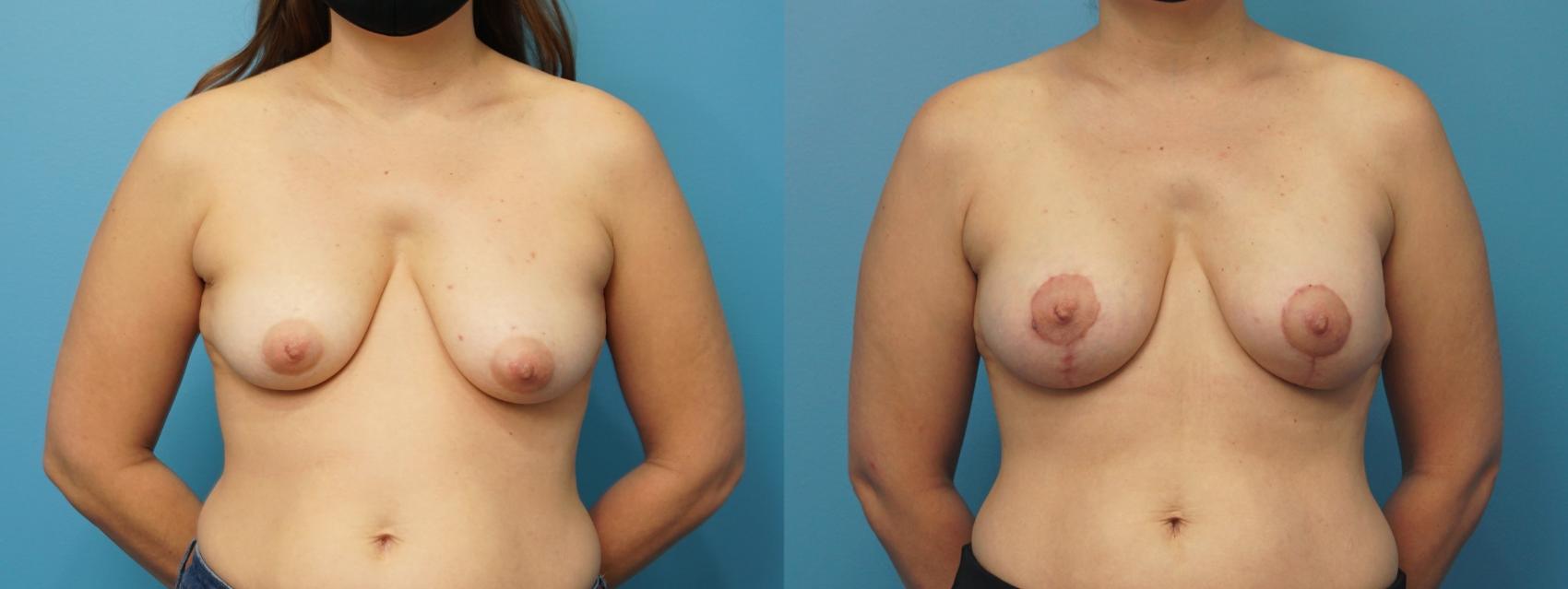 Before & After Breast Reconstruction with Implants Case 303 View #1 View in Northbrook, IL