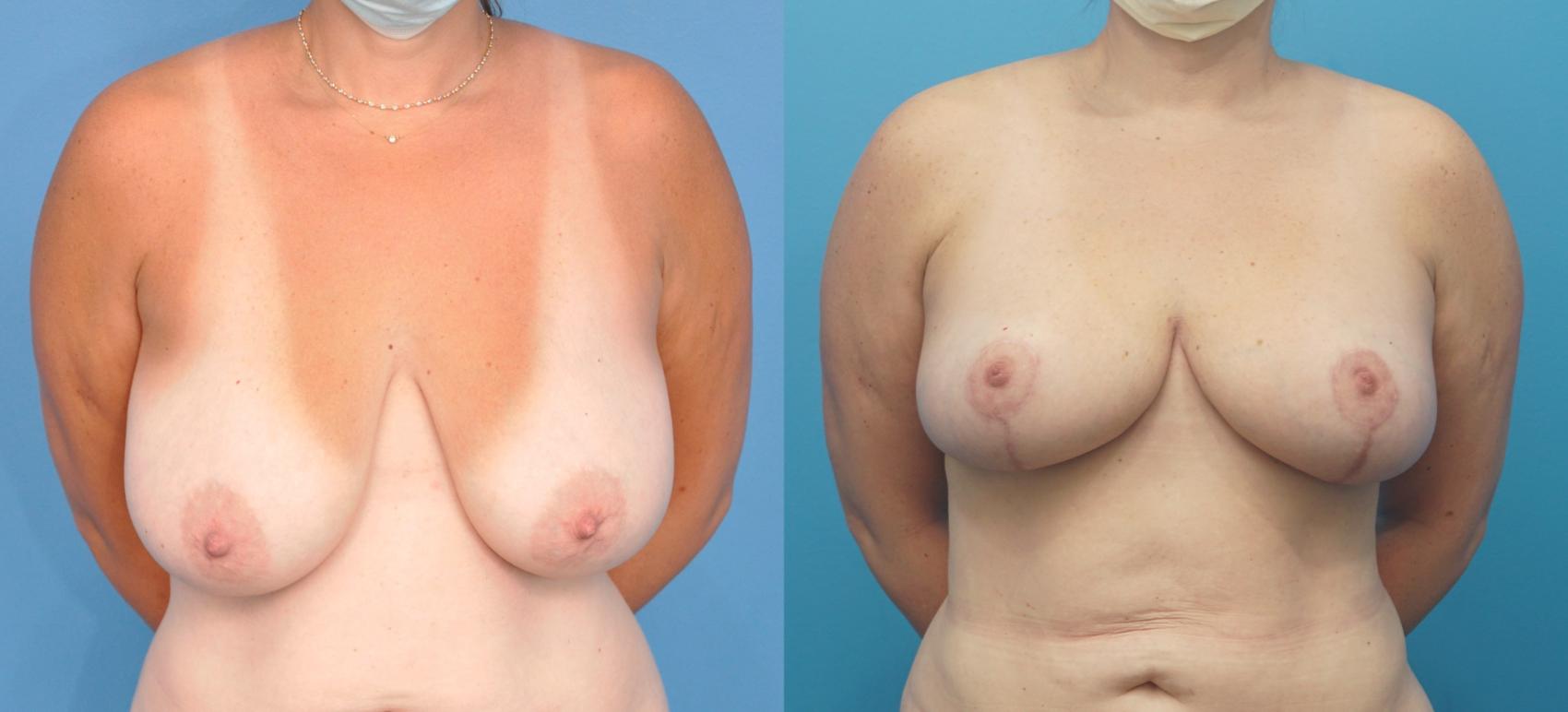 Before & After Liposuction Case 320 Front View in North Shore, IL