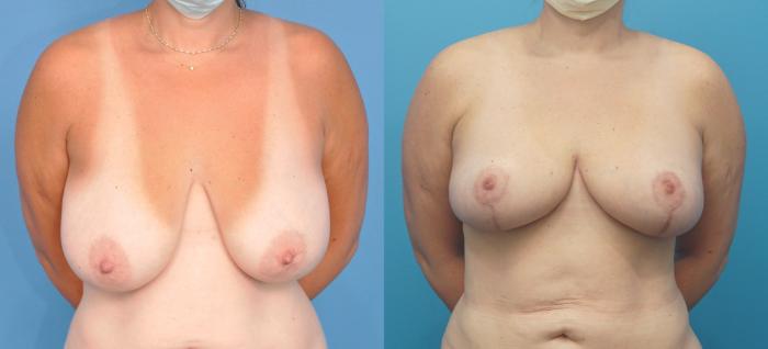 Before & After Liposuction Case 320 Front View in Northbrook, IL