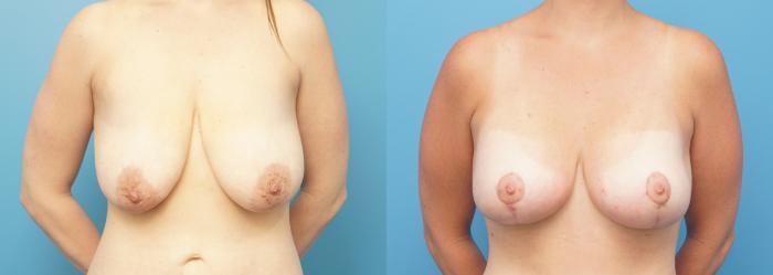 Before & After Breast Lift (Mastopexy) Case 323 Front View in North Shore, IL