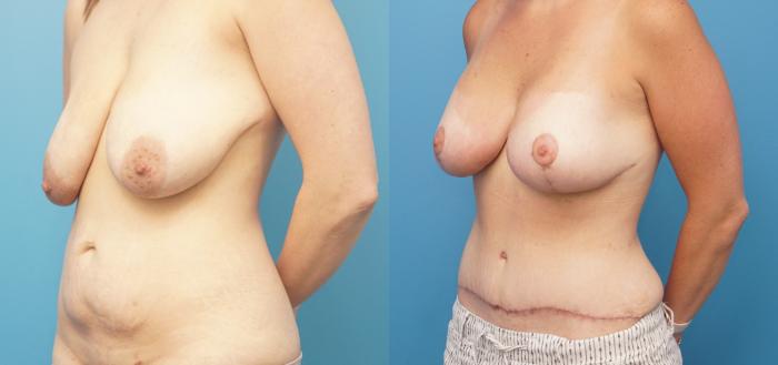 Before & After Breast Lift (Mastopexy) Case 323 Left Oblique 2 View in North Shore, IL