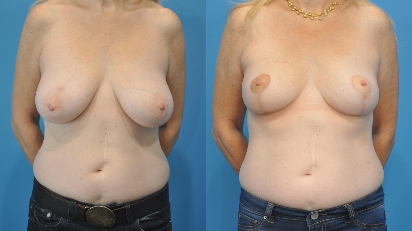 Before & After Breast Lift (Mastopexy) Case 338 Front View in Northbrook, IL
