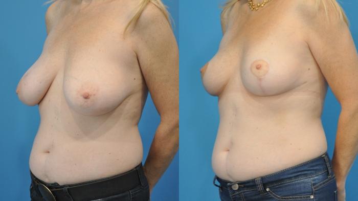 Before & After Breast Lift (Mastopexy) Case 338 Left Oblique View in North Shore, IL