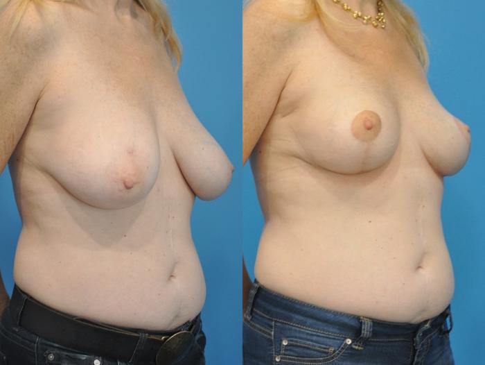 Before & After Breast Lift (Mastopexy) Case 338 Right Oblique View in North Shore, IL