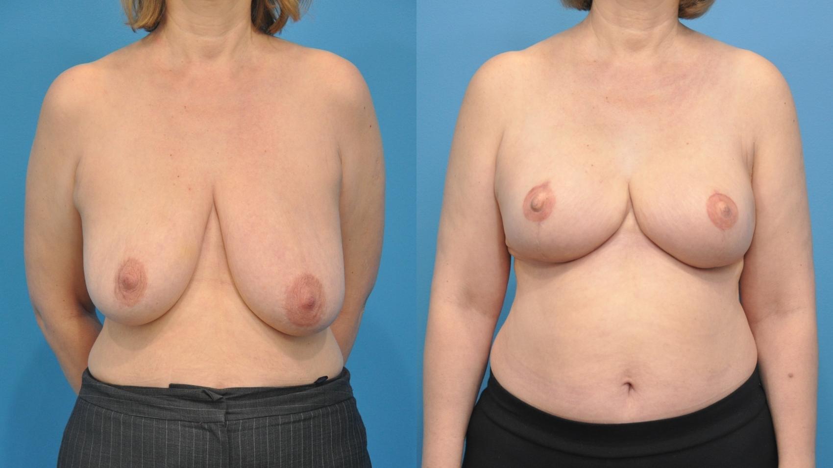 Before & After Breast Lift (Mastopexy) Case 352 Front View in Northbrook, IL