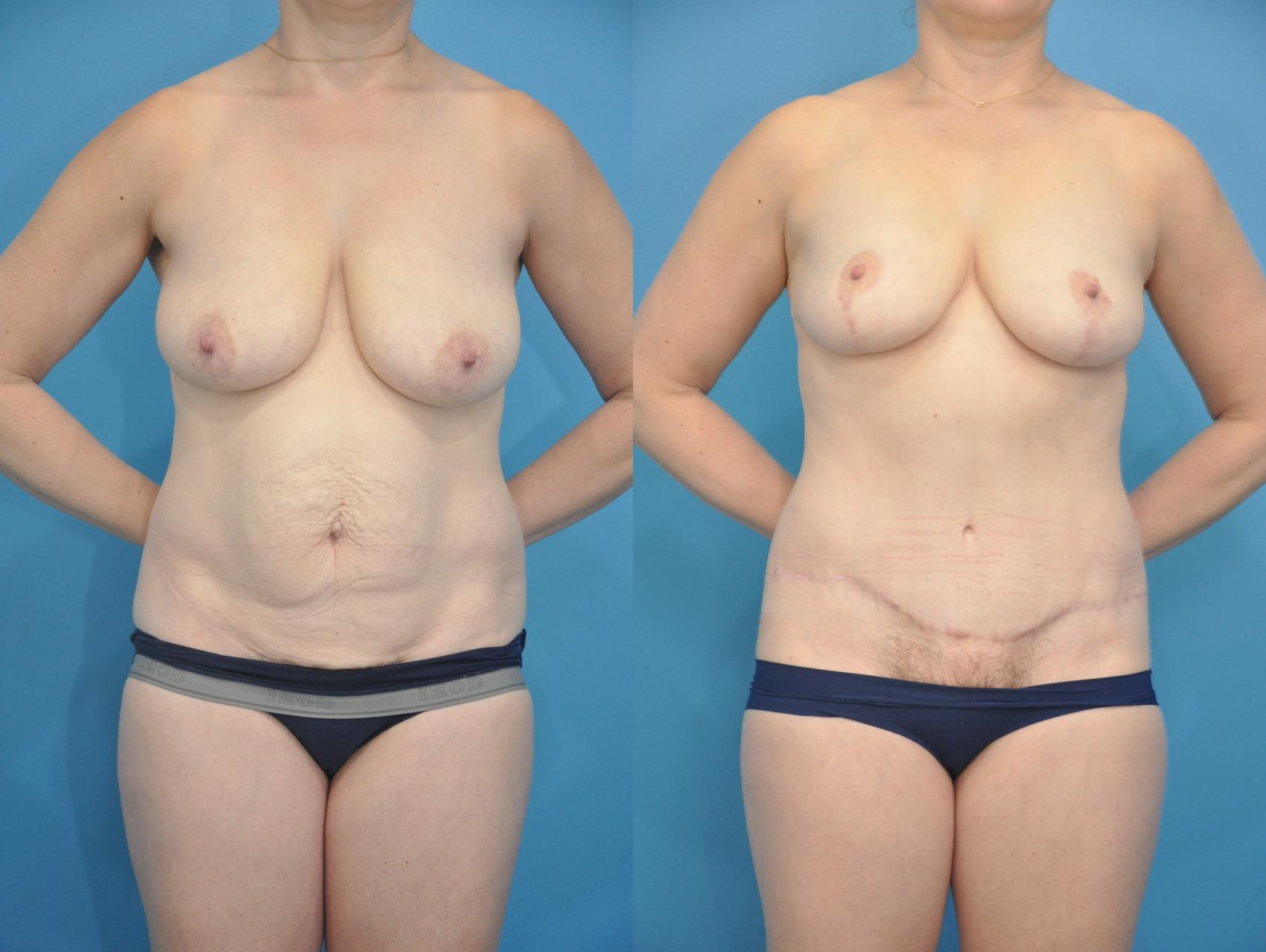 Before & After Breast Lift (Mastopexy) Case 353 Front View in Northbrook, IL