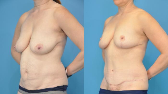 Before & After Breast Lift (Mastopexy) Case 353 Left Oblique View in Northbrook, IL