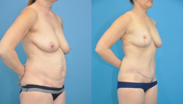 Before & After Abdominoplasty/Tummy Tuck Case 353 Right Oblique View in North Shore, IL