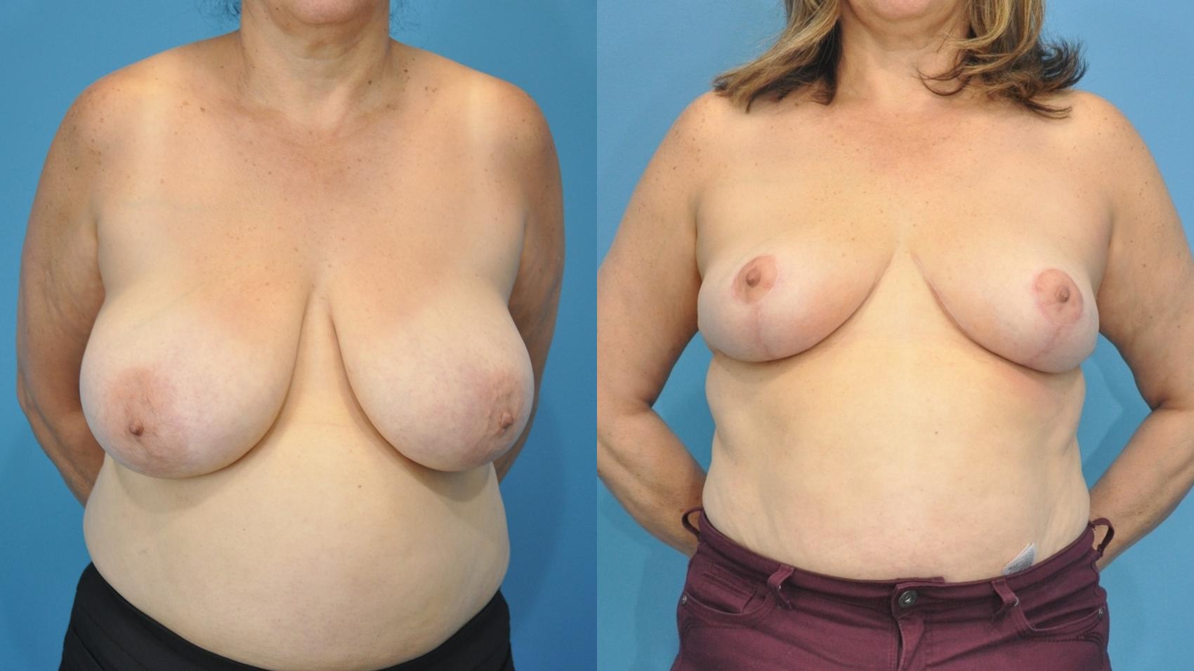 Before & After Breast Lift (Mastopexy) Case 357 Front View in North Shore, IL