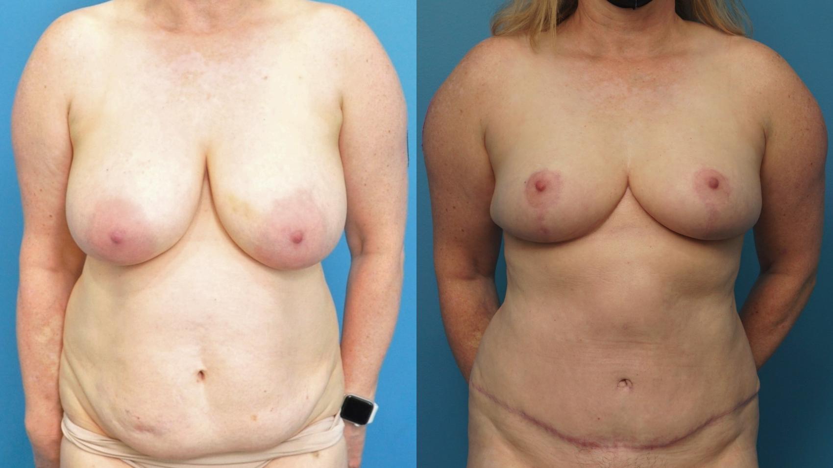 Before & After Abdominoplasty/Tummy Tuck Case 365 Front View in North Shore, IL