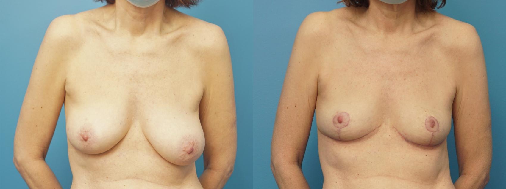 Before & After Breast Reduction Case 379 Front View in North Shore, IL