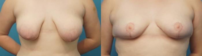 Before & After Breast Lift (Mastopexy) Case 382 Front View in North Shore, IL
