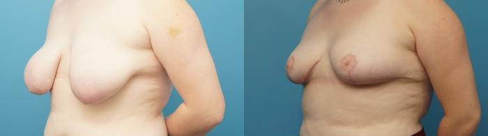 Before & After Breast Lift (Mastopexy) Case 382 Left Oblique View in North Shore, IL