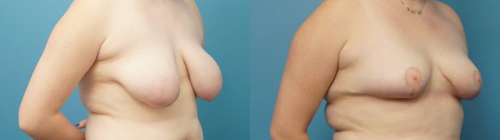 Before & After Breast Lift (Mastopexy) Case 382 Right Oblique View in North Shore, IL