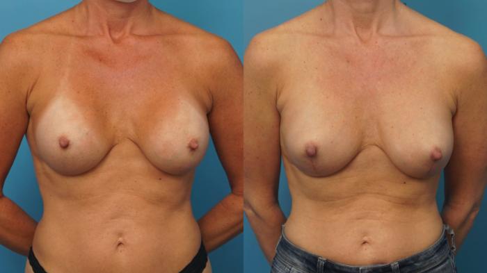 Before & After Revision Breast Surgery Case 406 Front View in Northbrook, IL