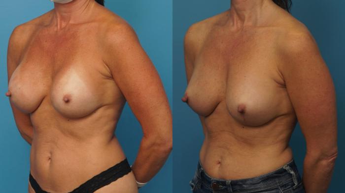 Before & After Revision Breast Surgery Case 406 Left Oblique View in North Shore, IL