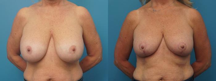 Before & After Breast Implant Removal Case 411 Front View in North Shore, IL