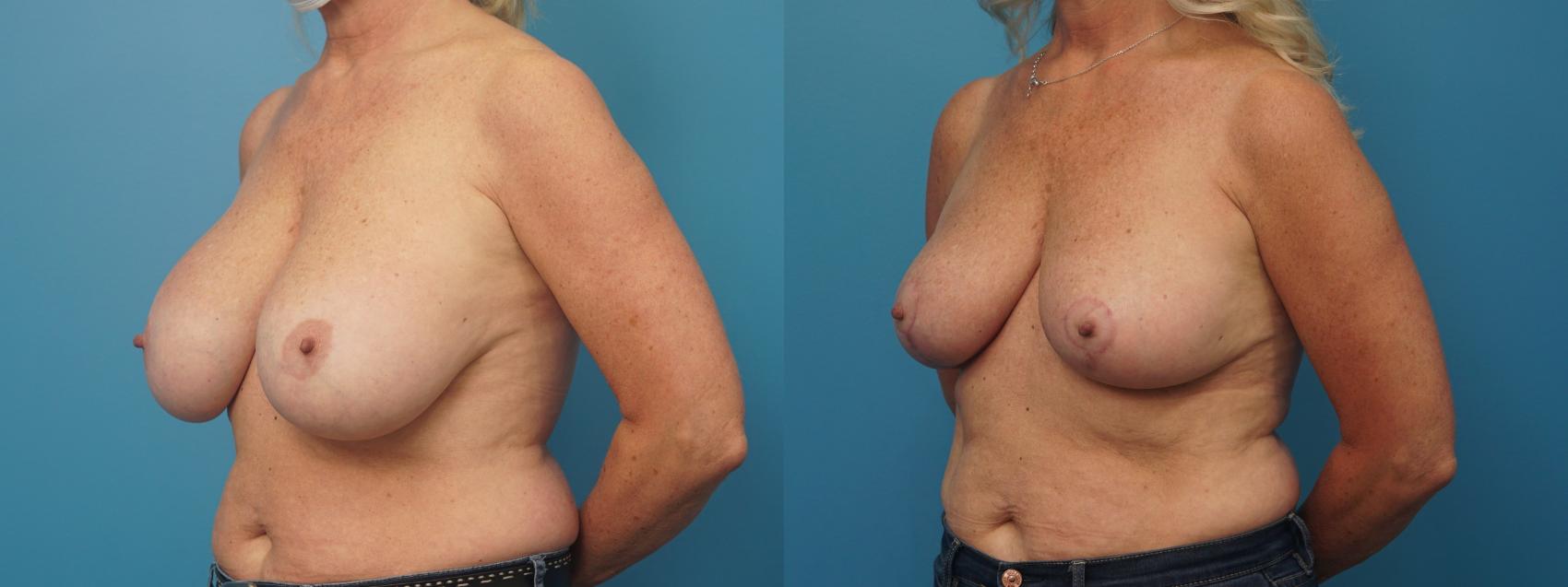 Before & After Breast Implant Removal Case 411 Left Oblique View in North Shore, IL