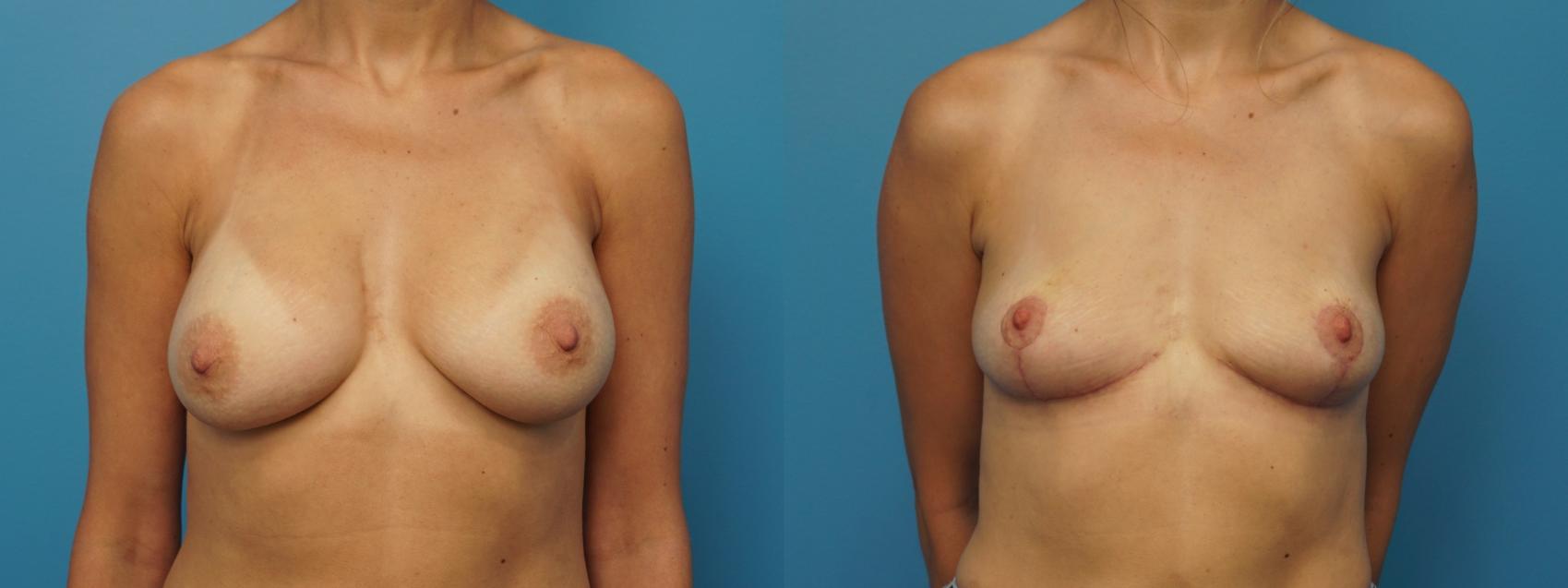Before & After Breast Lift (Mastopexy) Case 418 Front View in Northbrook, IL